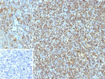 IHC staining of FFPE human tonsil tissue with CD74 antibody (clone CLIP/7947). Inset: PBS used in place of primary Ab (secondary Ab negative control). HIER: boil tissue sections in pH 9 10mM Tris with 1mM EDTA for 20 min and allow to cool before testing.