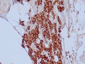 IHC staining of FFPE human mesothelioma tissue with Mesothelial Cell antibody (clone HBME-1). HIER: boil tissue sections in pH 9 10mM Tris with 1mM EDTA for 20 min and allow to cool before testing.