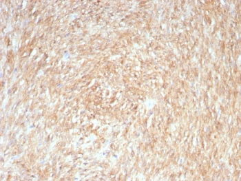 IHC testing of FFPE human gastrointestinal stromal tumor (GIST) with ANO1 antibody (clone rDG1/8750). Required HIER: boil tissue sections in pH 9 10mM Tris with 1mM EDTA for 10-20 min followed by cooling at RT for 20 min.