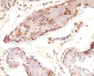 IHC testing of FFPE human testicular carcinoma with MAGE-1 antibody (clone MZ2E/838). Staining of formalin-fixed tissues requires boiling tissue sections in pH 9 10mM Tris with 1mM EDTA for 10-20 min followed by cooling at RT for 20 min.