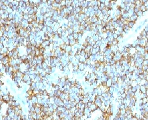 IHC testing of FFPE human Ewing's sarcoma and CD99 antibody (clone CDLA99). Staining of formalin-fixed tissues requires boiling tissue sections in pH 9 10mM Tris with 1mM EDTA for 10-20 min followed by cooling at RT for 20 min.
