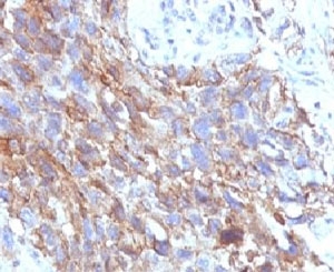IHC testing of FFPE human lung carcinoma with CD56 antibody (clone CDLA56).