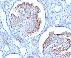 IHC testing of FFPE human mesothelioma with recombinant WT1 antibody (clone RMWT1-1). Required HIER: boil tissue sections in pH 9 10mM Tris with 1mM EDTA for 10-20 min followed by cooling at RT for 20 min.