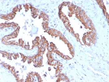 IHC staining of FFPE human prostate carcinoma with TMEPAI antibody (clone PMEPA1/2696). HIER: boil tissue sections in pH6, 10mM citrate buffer, for 10-20 min and allow to cool before testing.