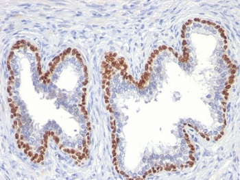 IHC testing of FFPE human prostate cancer with p63 antibody (clone TP63/11). HIER: boil tissue sections in pH 9 10mM Tris with 1mM EDTA for 10-20 min followed by cooling at RT for 20 min.