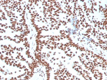 IHC staining of FFPE human breast carcinoma with Estrogen Receptor alpha antibody (clone ESR1/3556). HIER: boil tissue sections in pH 9 10mM Tris with 1mM EDTA for 10-20 min and allow to cool before testing.