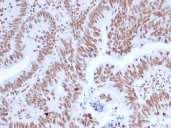 IHC staining of FFPE human colon carcinoma with NRF1 antibody (clone NRF1/2608). HIER: boil tissue sections in pH 9 10mM Tris with 1mM EDTA for 20 min and allow to cool before testing.
