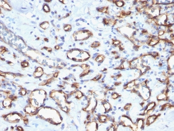 IHC staining of FFPE human angiosarcoma with CD34 antibody. HIER: boil tissue sections in pH 9 10mM Tris with 1mM EDTA for 20 min and allow to cool before testing.