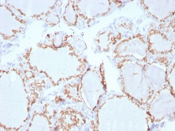 IHC staining of FFPE human thyroid carcinoma with Thyroid Peroxidase antibody. HIER: boil tissue sections in pH 9 10mM Tris with 1mM EDTA for 20 min and allow to cool before testing.