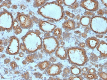 IHC staining of FFPE human thyroid carcinoma with TPO antibody. HIER: boil tissue sections in pH 9 10mM Tris with 1mM EDTA for 20 min and allow to cool before testing.