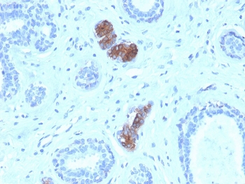 HC staining of FFPE human breast carcinoma with Mammaglobin antibody (clone MGB/4056). HIER: boil tissue sections in pH 9 10mM Tris with 1mM EDTA for 20 min and allow to cool before testing.