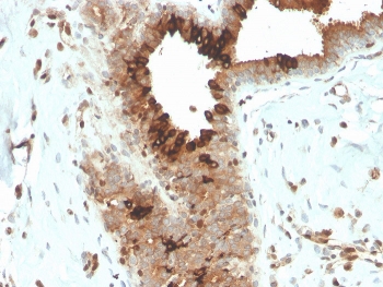 IHC staining of FFPE human breast carcinoma with recombinant Mammaglobin antibody (clone MGB/4057R). HIER: boil tissue sections in pH 9 10mM Tris with 1mM EDTA for 20 min and allow to cool before testing.