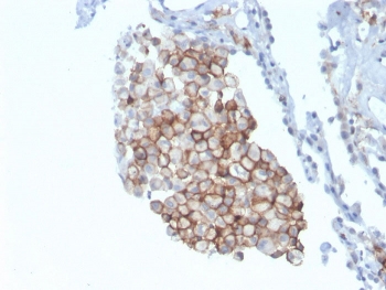 IHC staining of FFPE human lung carcinoma with CD86 antibody (clone C86/3711). HIER: boil tissue sections in pH 9 10mM Tris with 1mM EDTA for 20 min and allow to cool before testing.