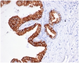 IHC staining of FFPE human prostate carcinoma tissue with recombinant EpCAM antibody (clone rEGP40/826). HIER: boil tissue sections in pH 9 10mM Tris with 1mM EDTA for 20 min and allow to cool before testing.