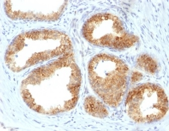 IHC staining of FFPE human prostate cancer with COX2 antibody (clone COX2/2377). HIER: boil tissue sections in pH 9 10mM Tris with 1mM EDTA for 20 min and allow to cool before testing.