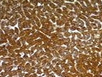 IHC: Formalin-fixed, paraffin-embedded human hepatocellular carcinoma stained with Hepatocyte antibody (SPM582).