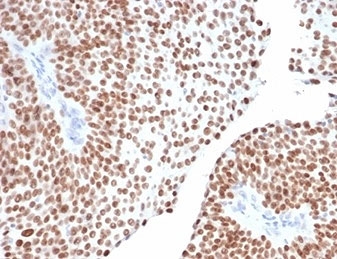 IHC staining of FFPE human bladder tissue with GATA Binding Protein 3 antibody (clone GATA3/6664). HIER: boil tissue sections in pH 9 10mM Tris with 1mM EDTA for 20 min and allow to cool before testing.