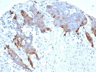 IHC staining of FFPE human ovarian carcinoma tissue with recombinant Transglutaminase 2 antibody (clone TGM2/6943R). HIER: boil tissue sections in pH 9 10mM Tris with 1mM EDTA for 20 min and allow to cool before testing.